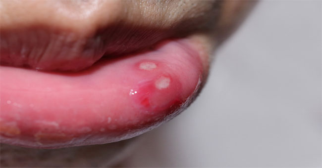 Tìm Hiểu Nhiệt Miệng: Nguyên Nhân, Triệu Chứng và Phương Pháp Điều Trị Hiệu Quả