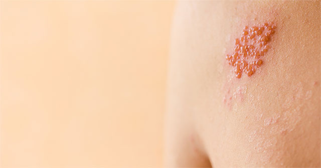 Hiểu Biết Về Bệnh Zona Thần Kinh: Triệu Chứng, Nguyên Nhân và Cách Điều Trị