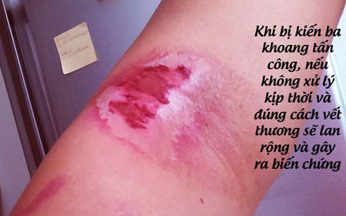 Khi bị kiến ba khoang tấn công, nếu không xử lý kịp thời dễ gây ra biến chứng. Khi bị kiến ba khoang tấn công, nếu không xử lý kịp thời dễ gây ra biến chứng.