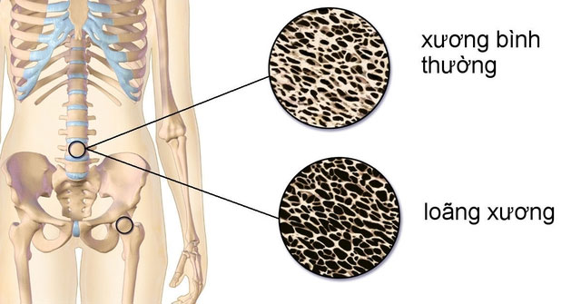 Những Thực Phẩm Nguy Hại Khiến Xương Giòn Yếu Hơn