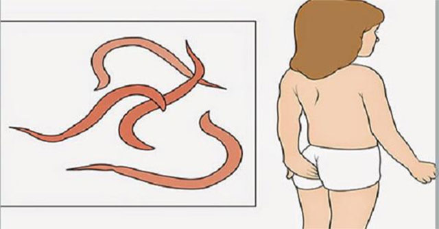 Bắt giun kim cho trẻ em: phương pháp an toàn tại nhà và những gì phụ huynh cần biết